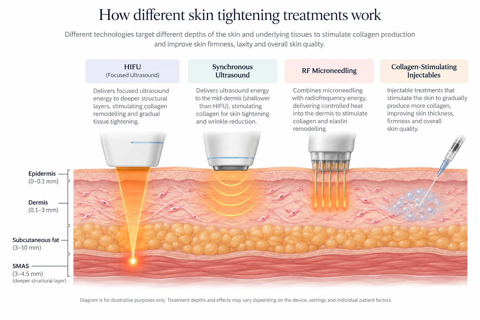 How different skin tightening treatments work: HIFU, synchronous ultrasound, RF microneedling and collagen-stimulating injectables, shown against the epidermis, dermis, subcutaneous fat and SMAS layers