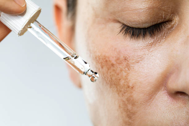 Melasma presenting as patchy brown discoloration on the face