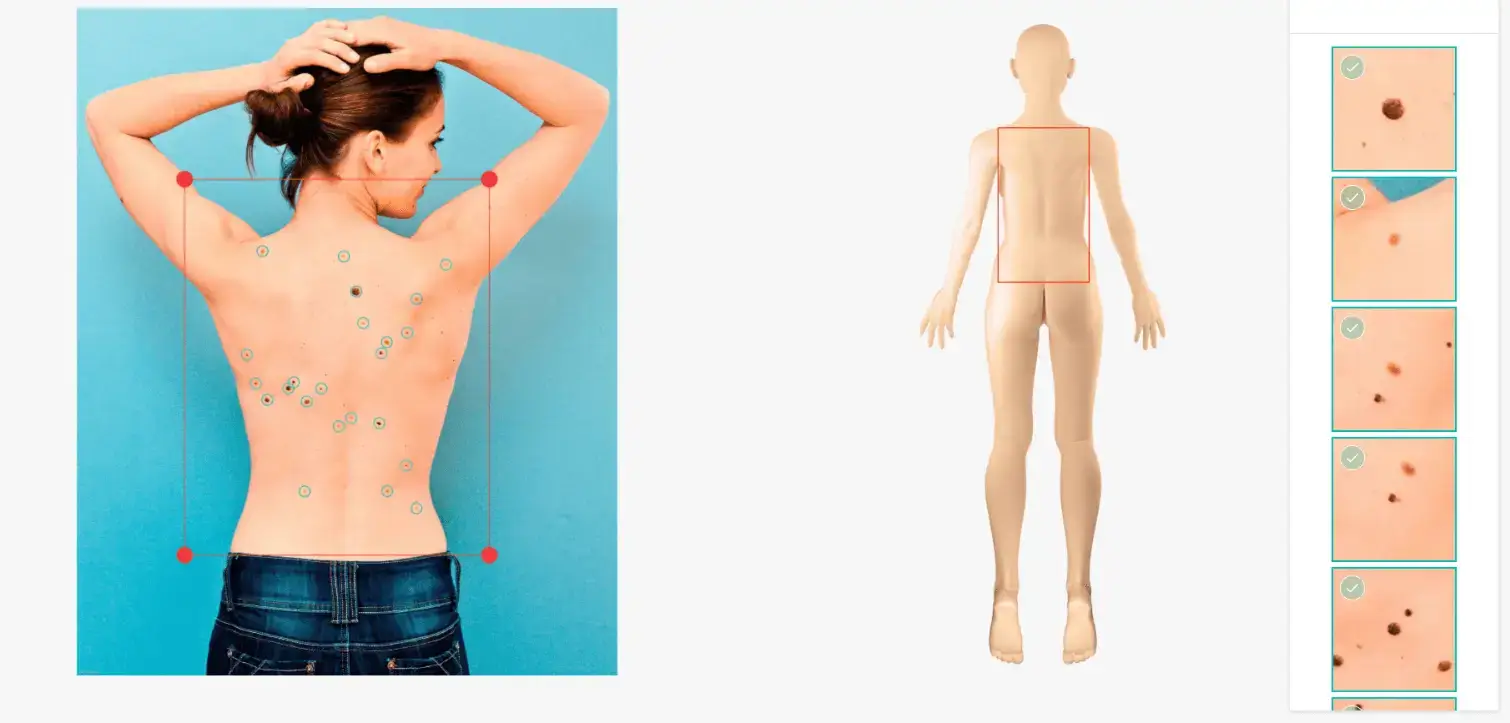 AI-assisted mole mapping capturing high-quality images of the skin, recording the location of individual moles and creating a digital map for future comparison